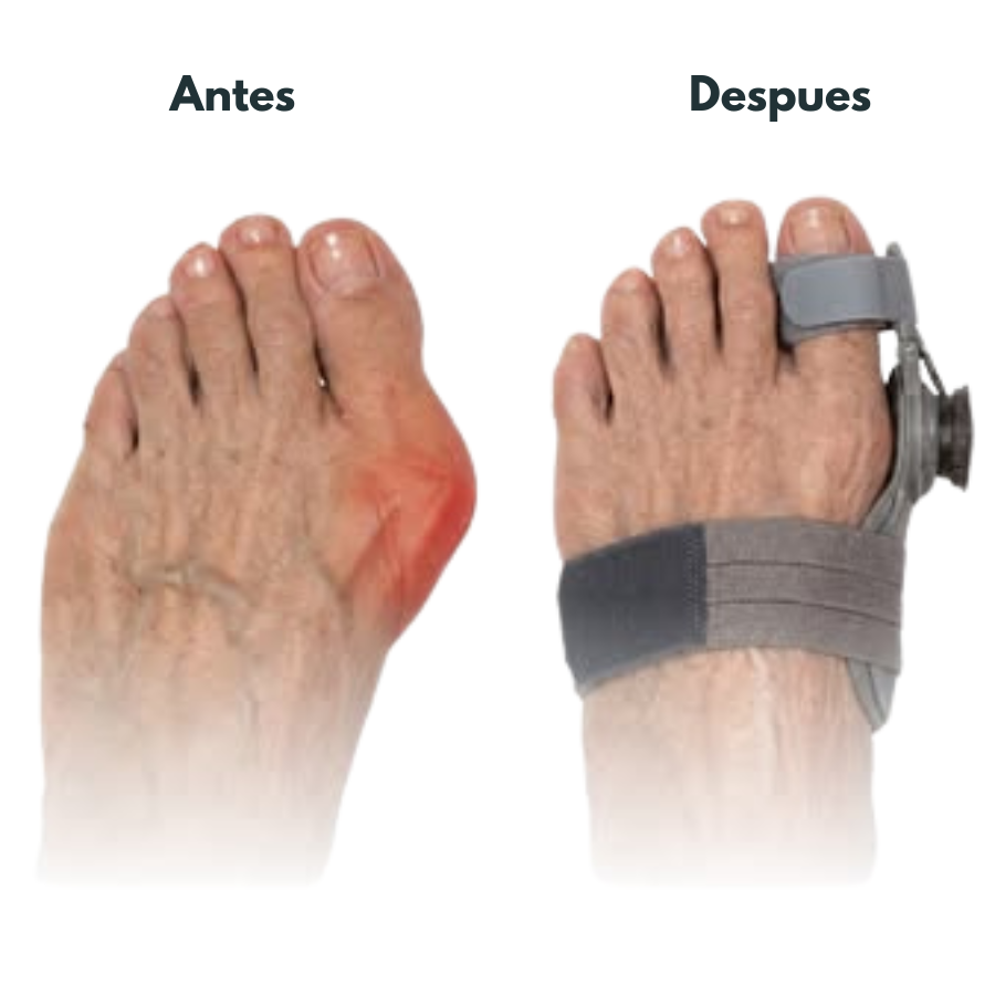 Corrector Inteligente de Juanetes Con Perilla Ajustable - Resultados en semanas