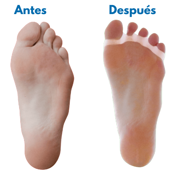 Corrector de Juanete de Silicona - Alivio del dolor de juanetes
